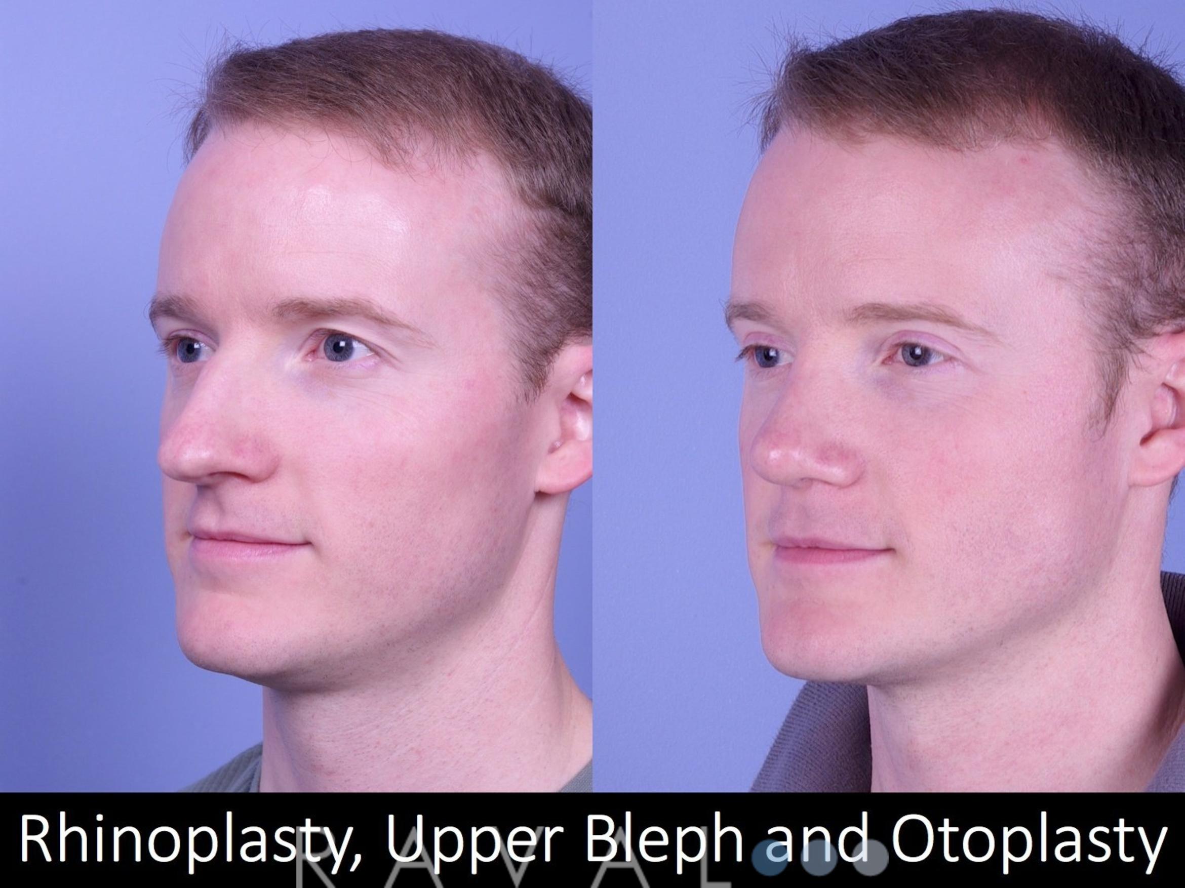 Before & After Rhinoplasty Case 1018 View 3 View in Denver, CO