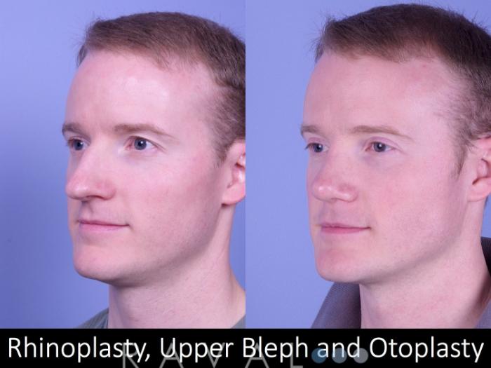 Before & After Rhinoplasty Case 1018 View 3 View in Denver, CO