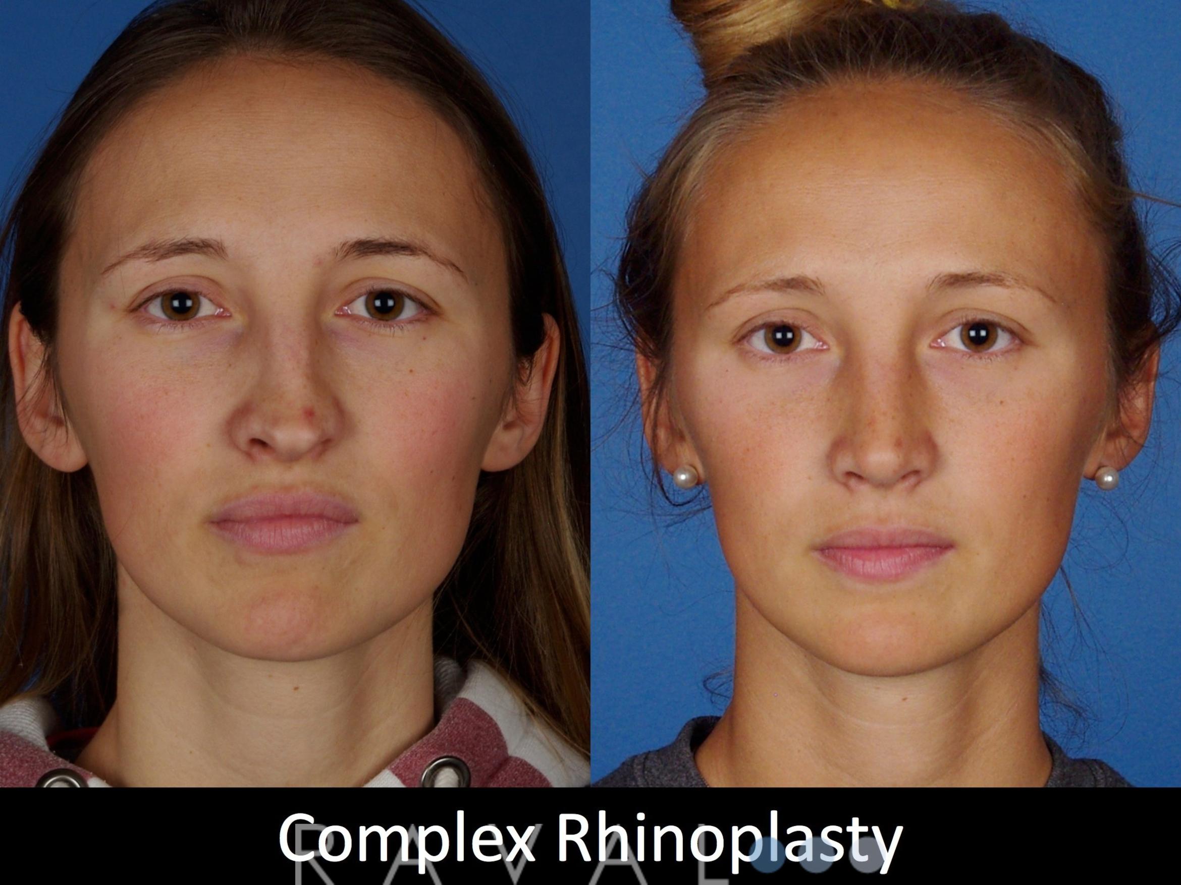 Before & After Rhinoplasty Case 1019 View 1 View in Denver, CO