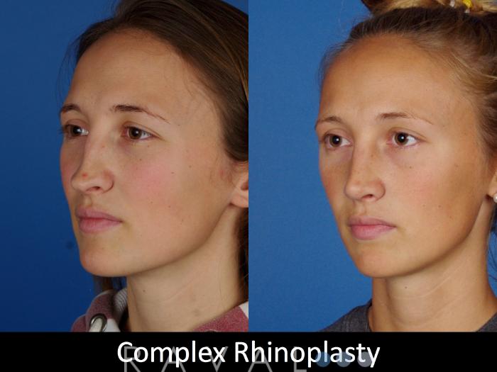 Before & After Rhinoplasty Case 1019 View 2 View in Denver, CO