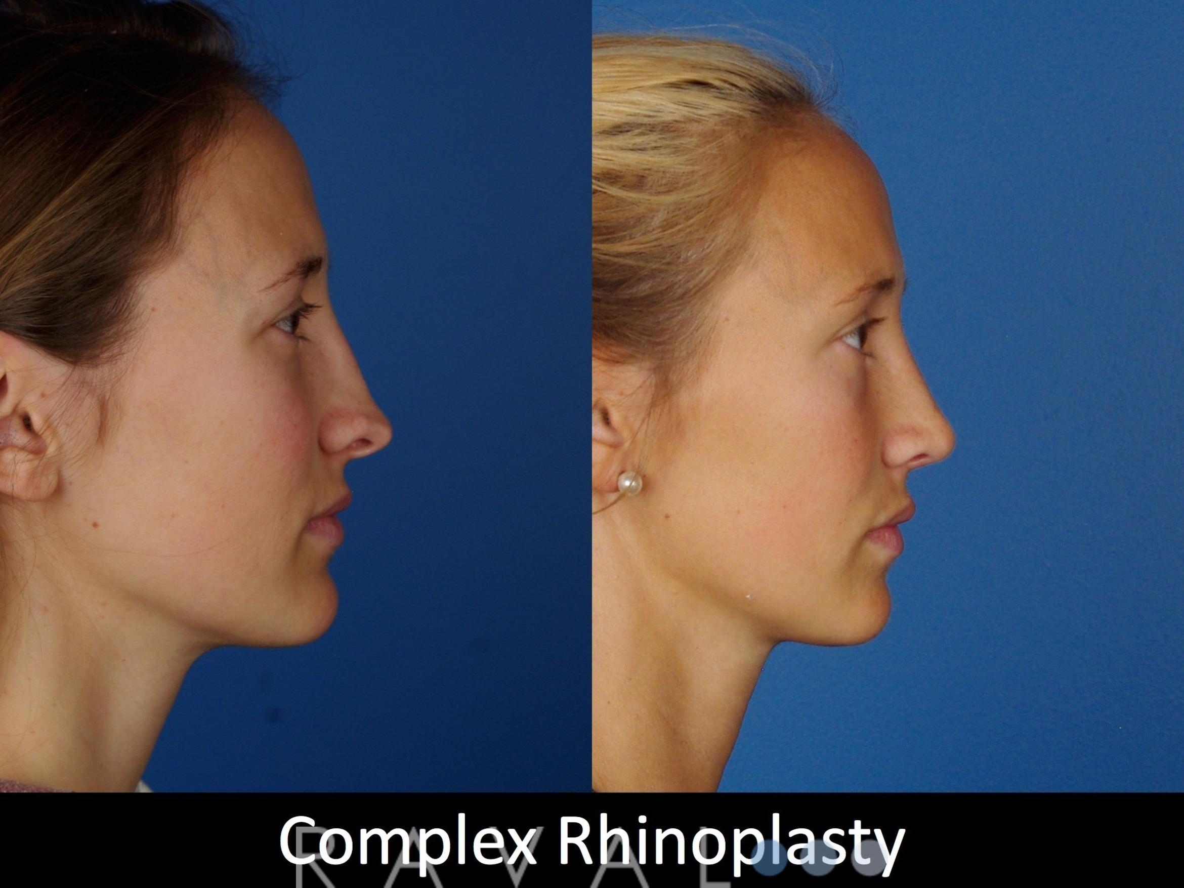 Before & After Rhinoplasty Case 1019 View 3 View in Denver, CO