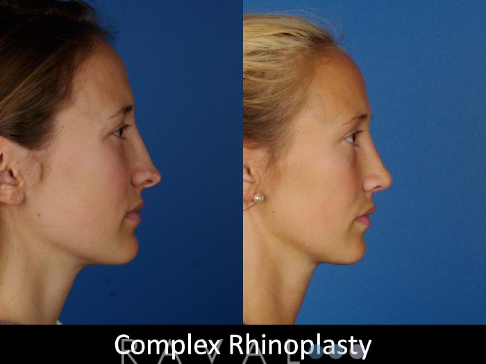 Before & After Rhinoplasty Case 1019 View 3 View in Denver, CO