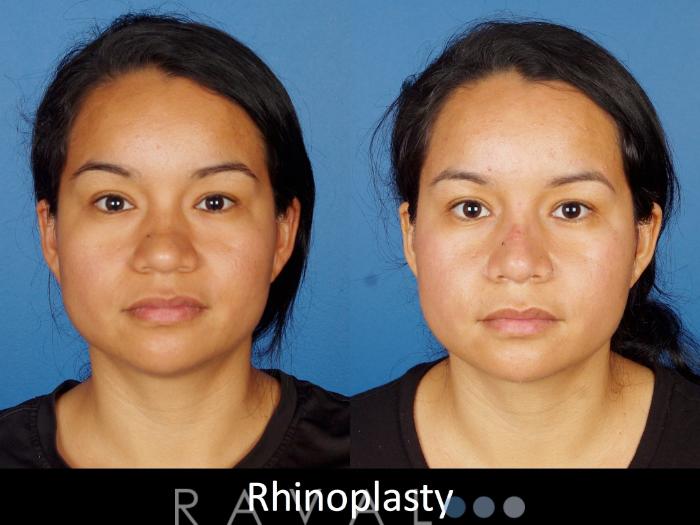 Before & After Rhinoplasty Case 1020 View 1 View in Denver, CO