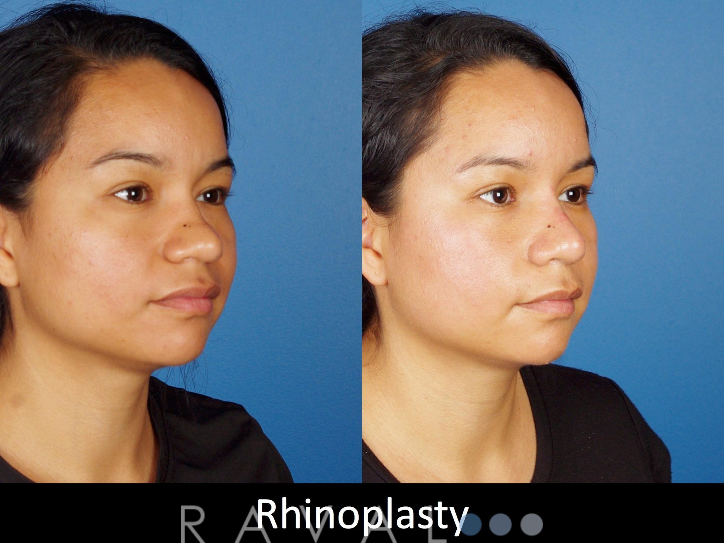 Before & After Rhinoplasty Case 1020 View 2 View in Denver, CO