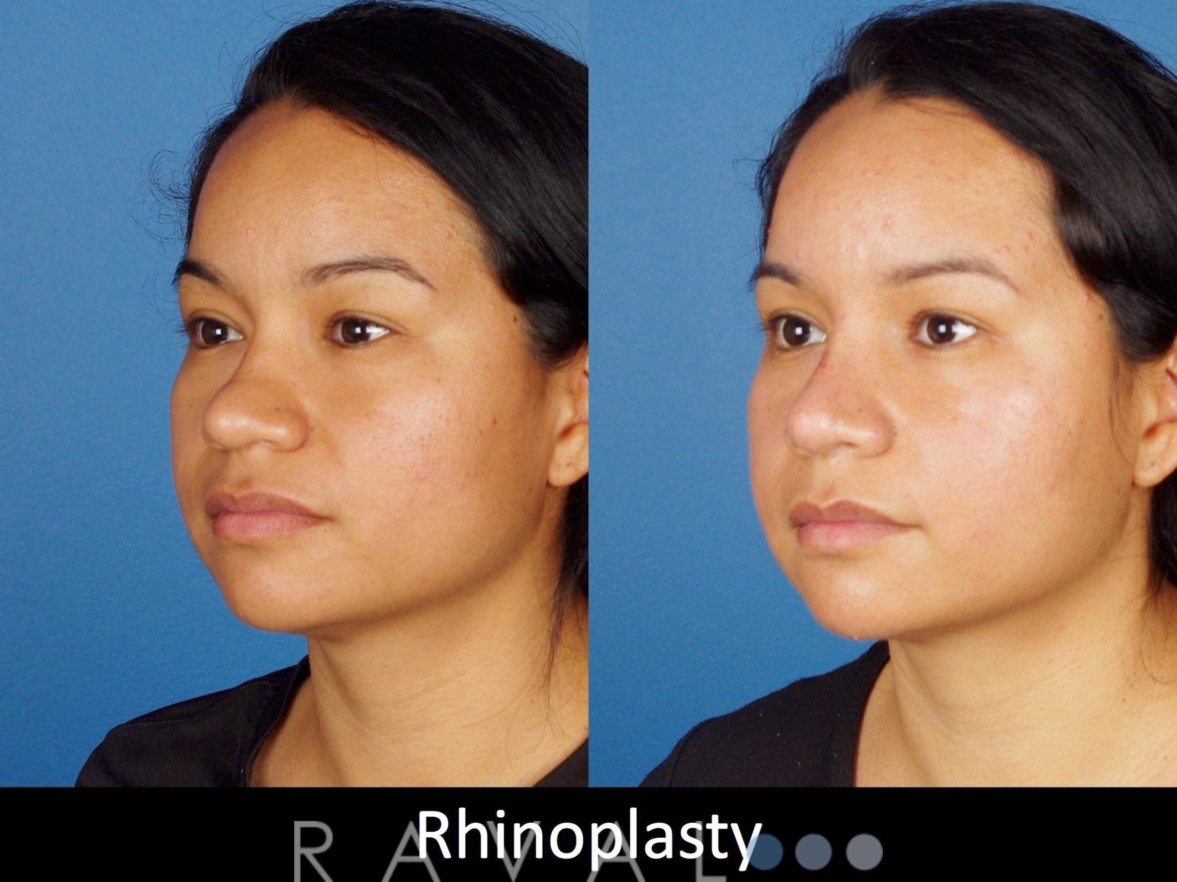 Before & After Rhinoplasty Case 1020 View 3 View in Denver, CO
