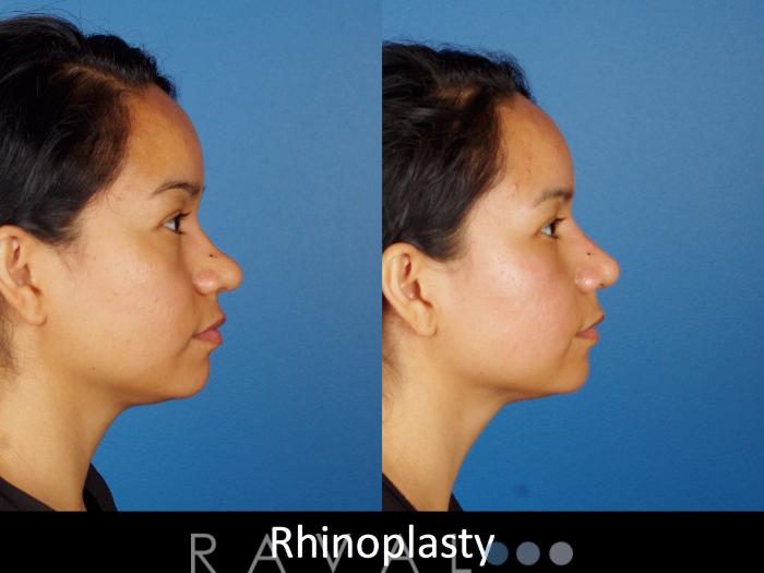 Before & After Rhinoplasty Case 1020 View 4 View in Denver, CO