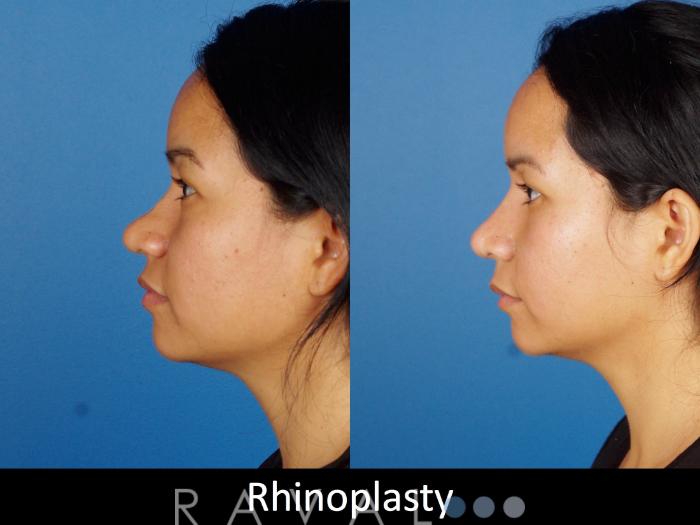 Before & After Rhinoplasty Case 1020 View 5 View in Denver, CO