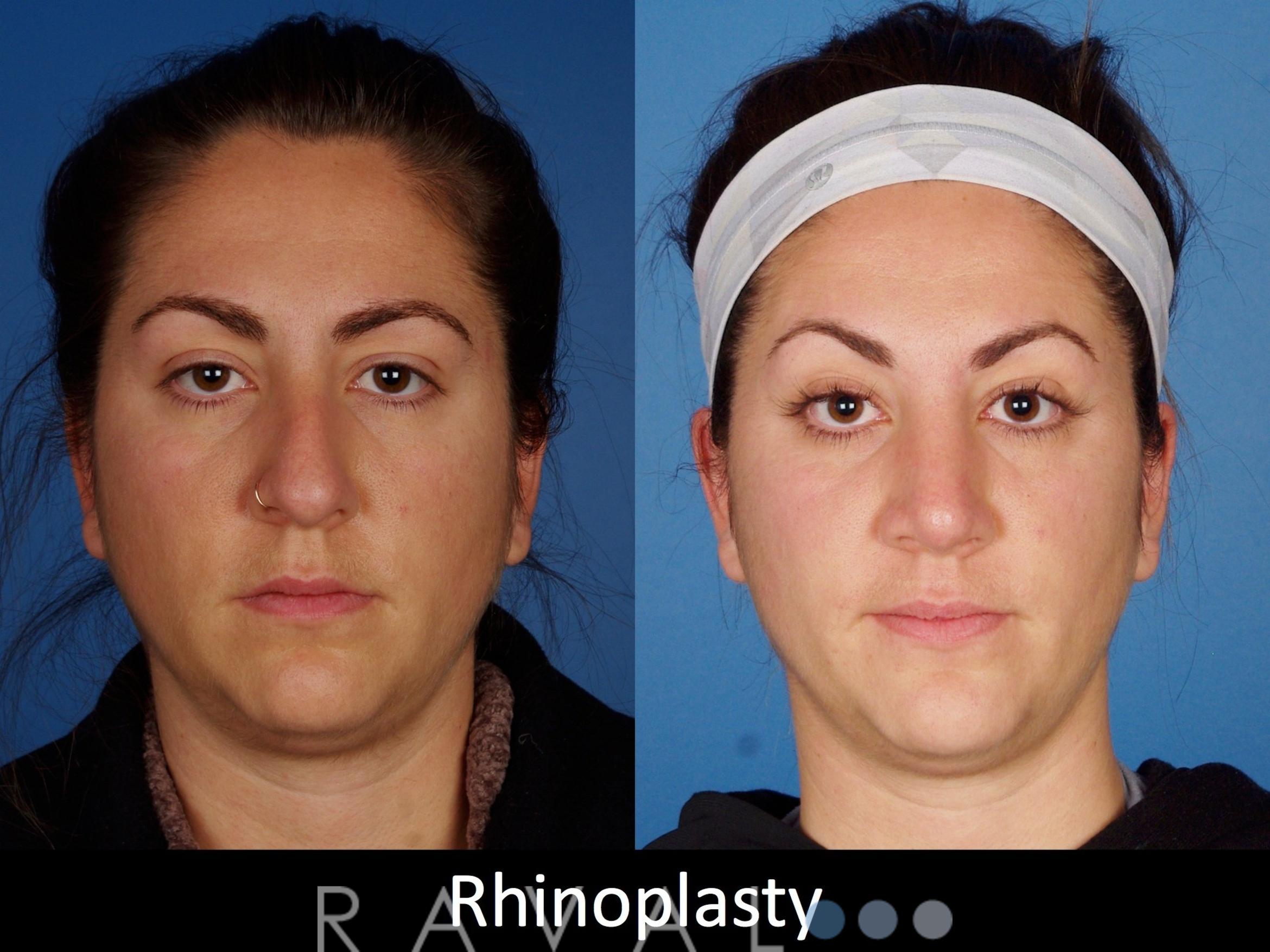 Before & After Rhinoplasty Case 1021 View 1 View in Denver, CO