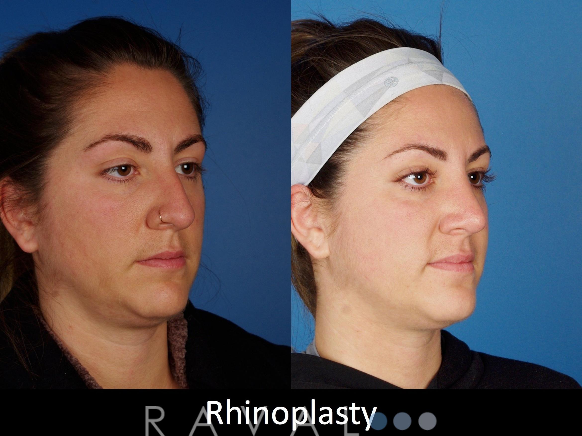 Before & After Rhinoplasty Case 1021 View 2 View in Denver, CO