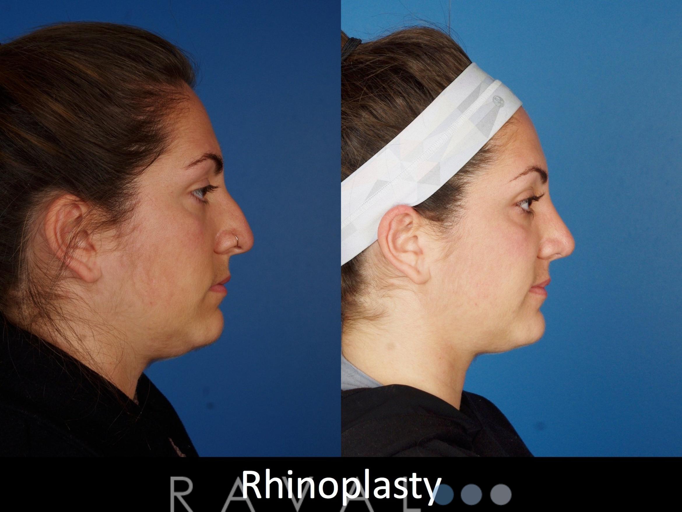 Before & After Rhinoplasty Case 1021 View 3 View in Denver, CO