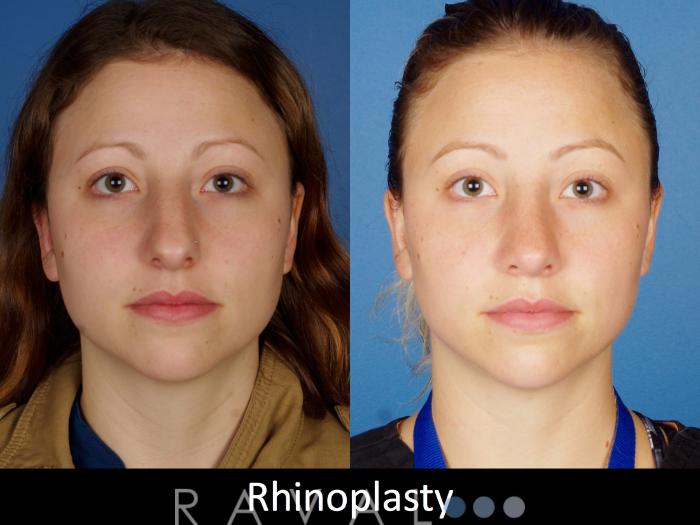 Before & After Rhinoplasty Case 1022 View 1 View in Denver, CO