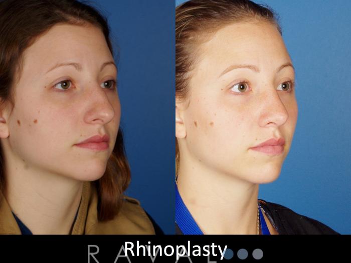 Before & After Rhinoplasty Case 1022 View 2 View in Denver, CO