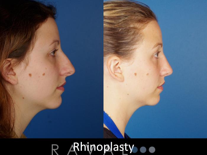 Before & After Rhinoplasty Case 1022 View 3 View in Denver, CO