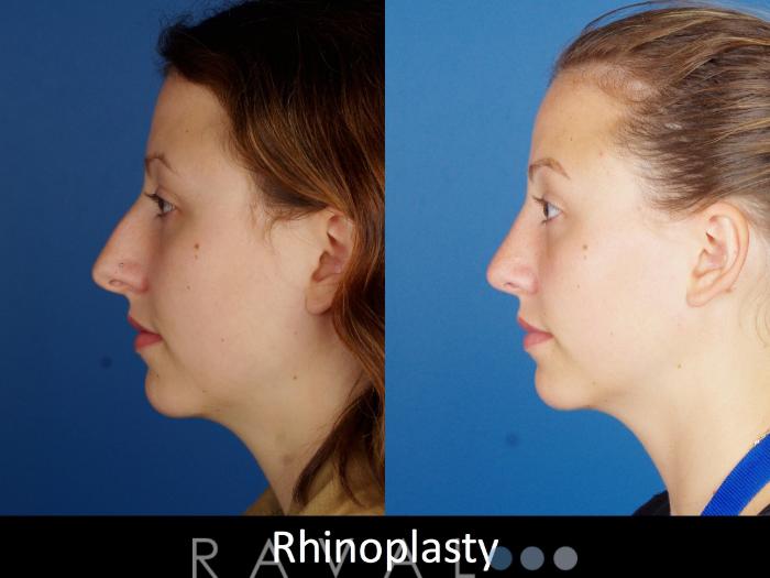 Before & After Rhinoplasty Case 1022 View 4 View in Denver, CO