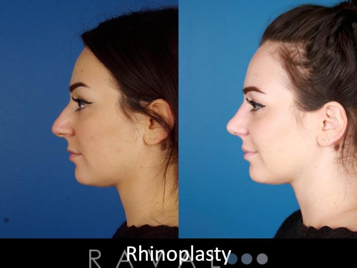 Before & After Rhinoplasty Case 1023 View 2 View in Denver, CO