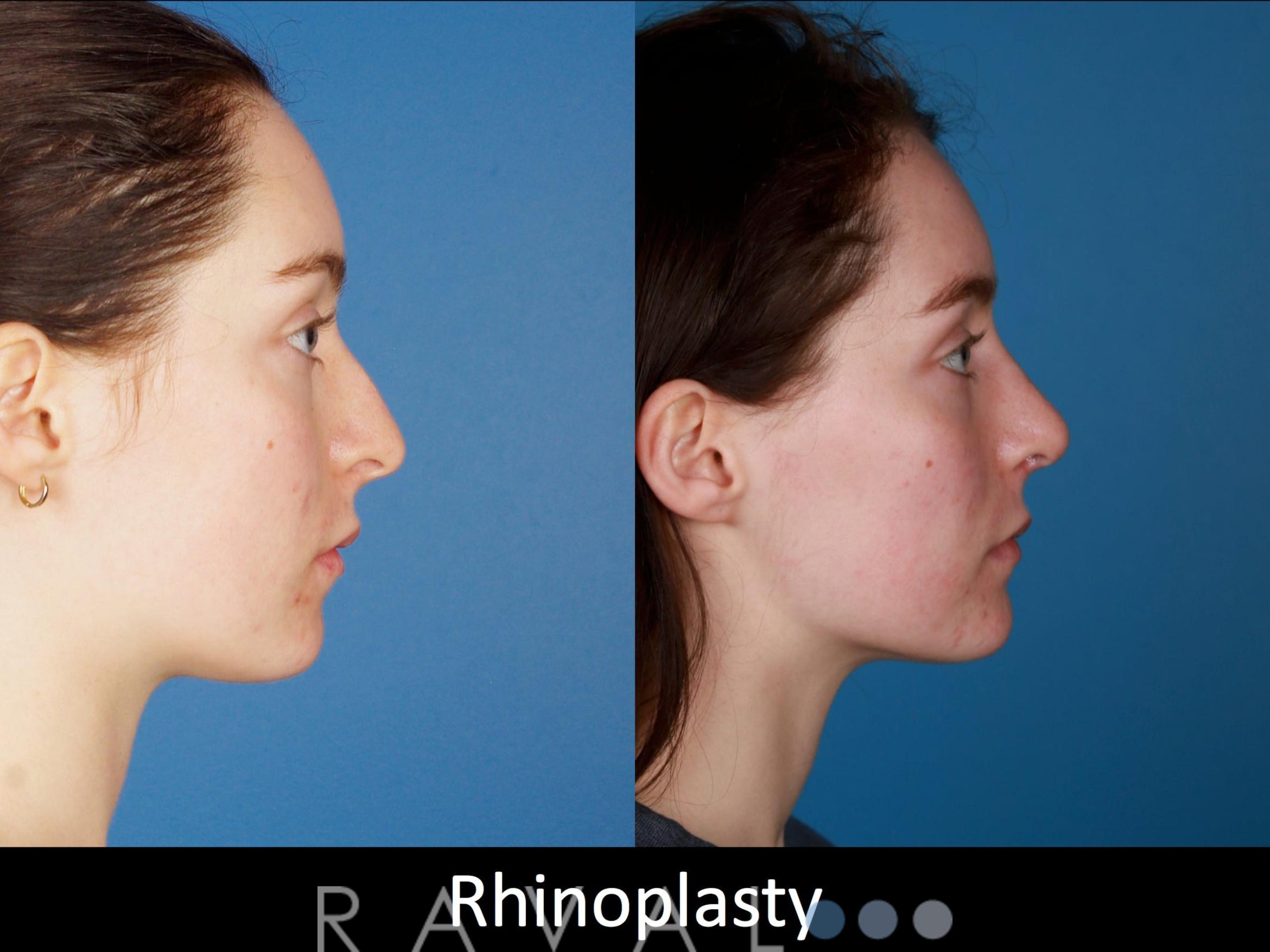 Before & After Rhinoplasty Case 1024 View 1 View in Denver, CO
