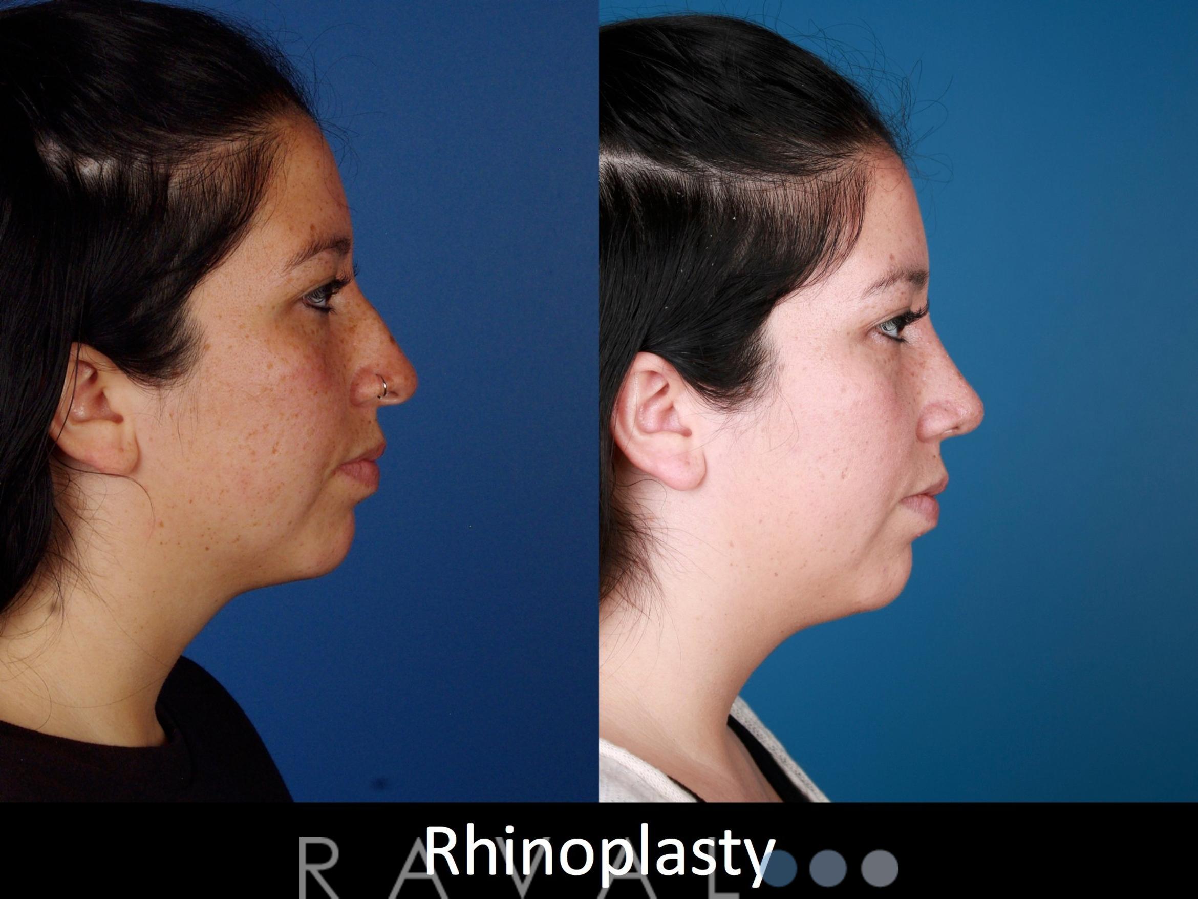 Before & After Rhinoplasty Case 1026 View 2 View in Denver, CO
