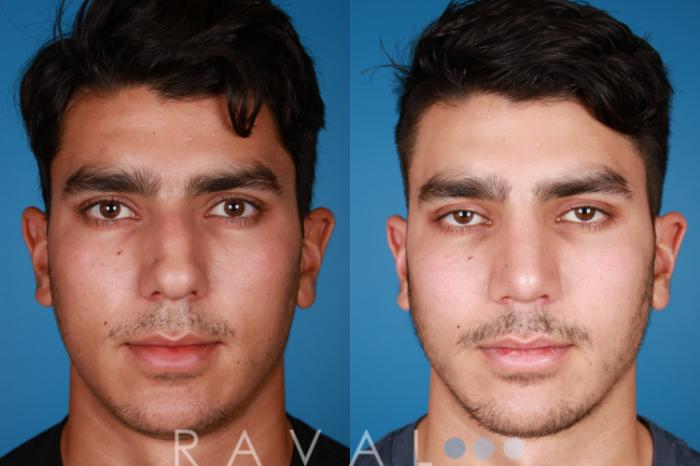 Before & After Rhinoplasty Case 1027 View 1 View in Denver, CO