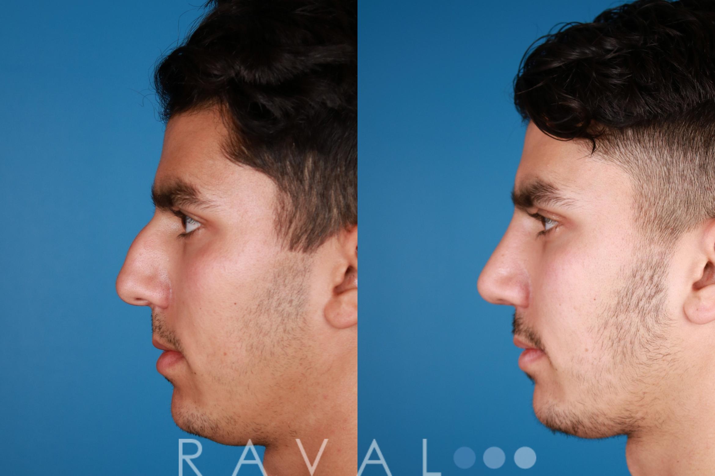 Before & After Rhinoplasty Case 1027 View 2 View in Denver, CO