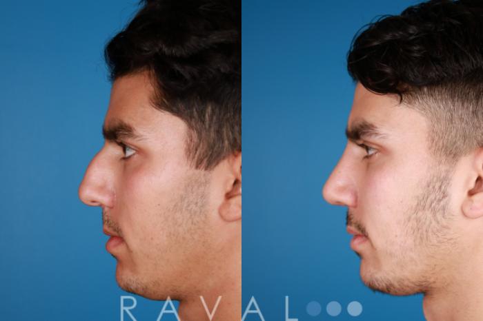 Before & After Rhinoplasty Case 1027 View 2 View in Denver, CO