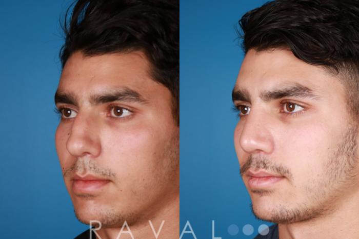 Before & After Rhinoplasty Case 1027 View 3 View in Denver, CO