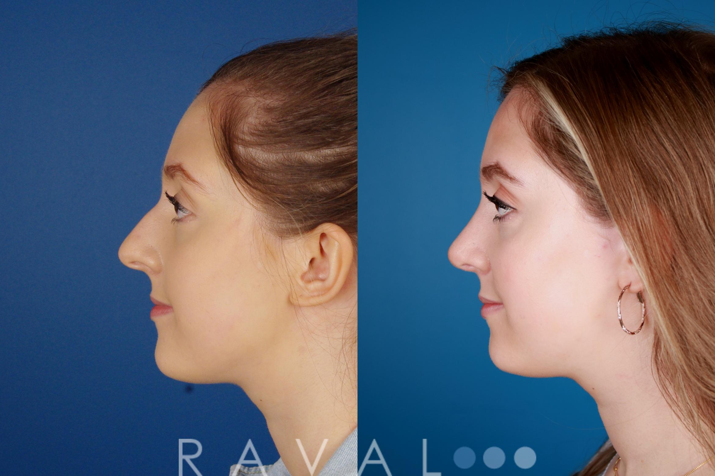 Before & After Rhinoplasty Case 1029 View 1 View in Denver, CO