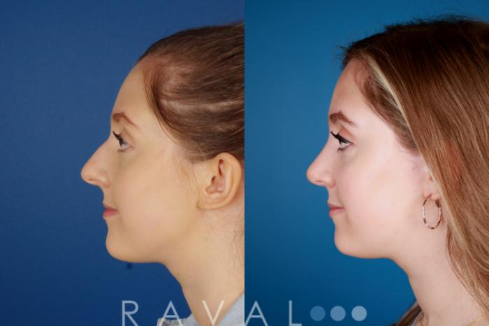 Before & After Rhinoplasty Case 1029 View 1 View in Denver, CO