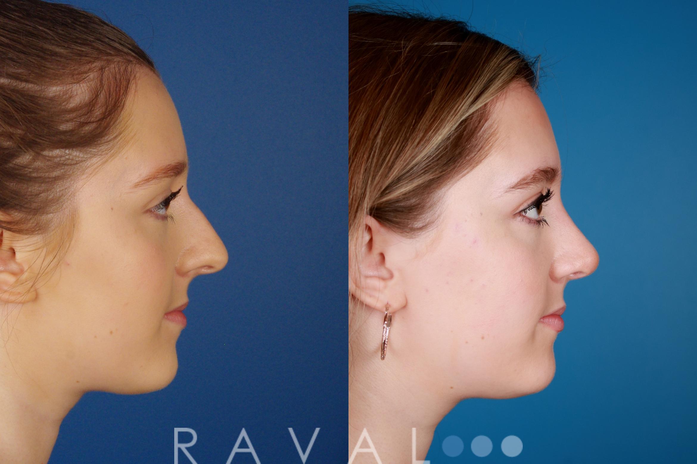 Before & After Rhinoplasty Case 1029 View 2 View in Denver, CO