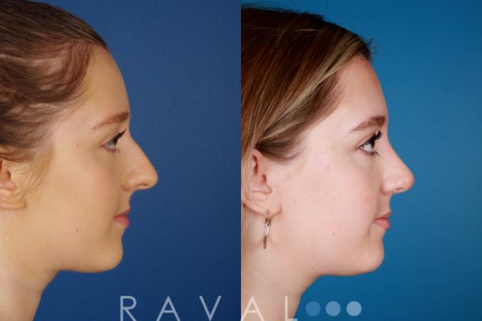 Before & After Rhinoplasty Case 1029 View 2 View in Denver, CO