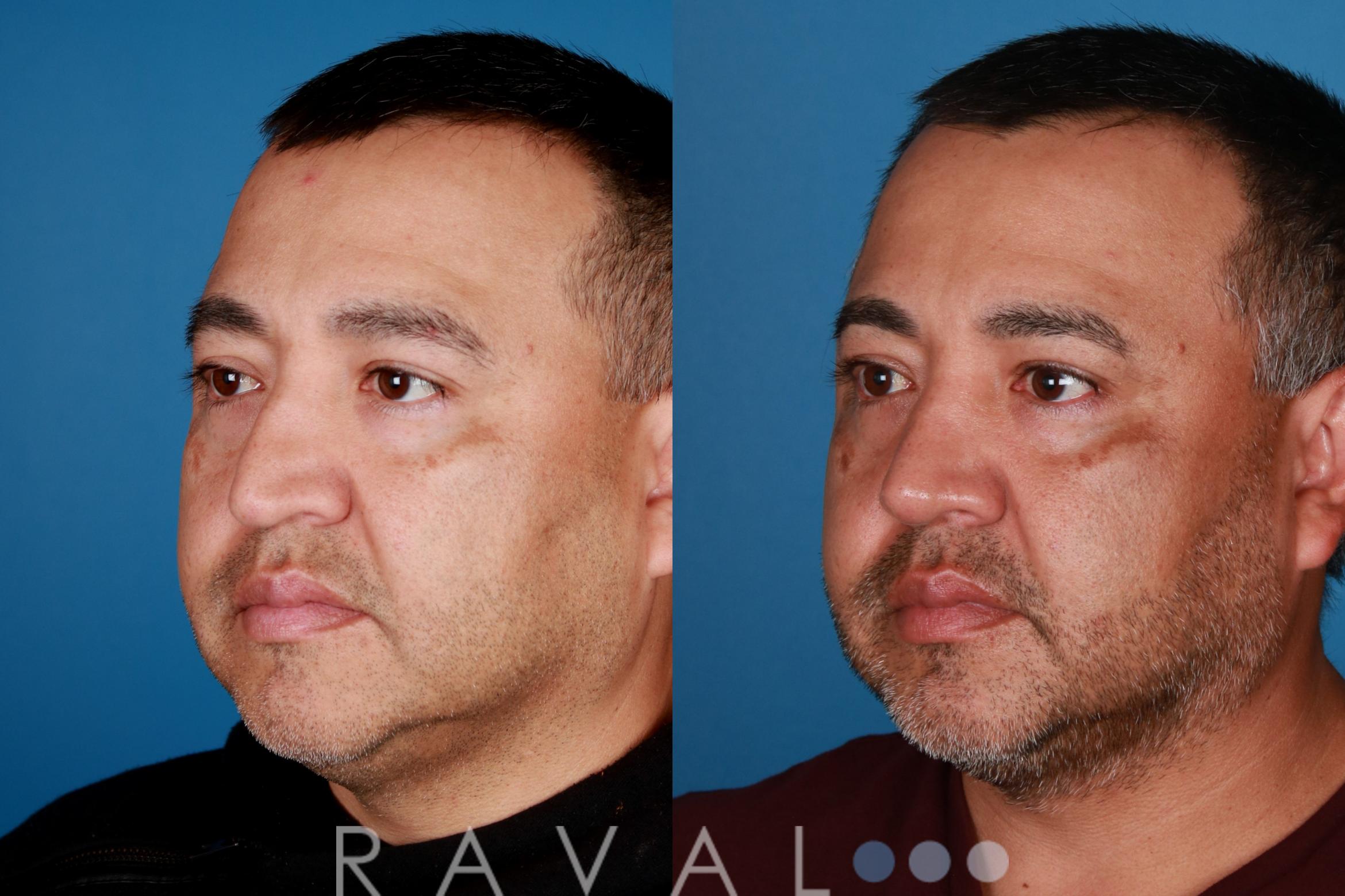 Before & After Rhinoplasty Case 1030 View 1 View in Denver, CO