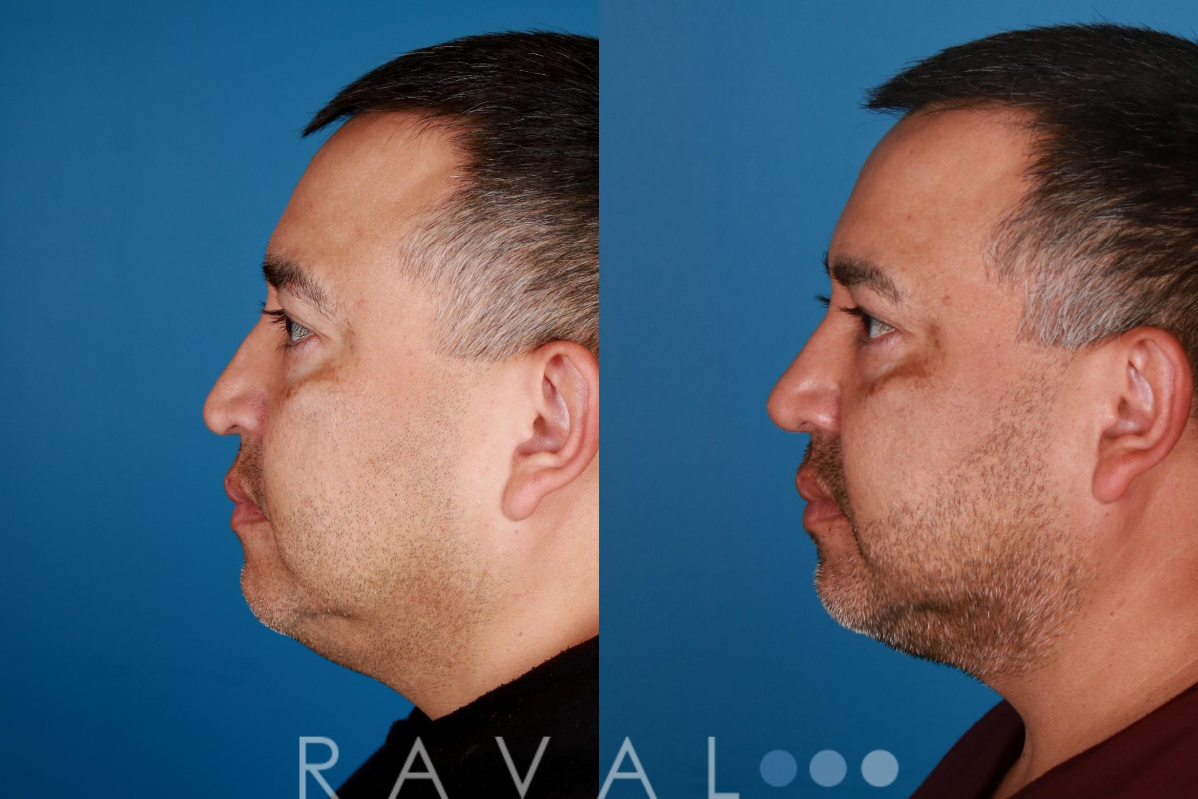 Before & After Rhinoplasty Case 1030 View 2 View in Denver, CO