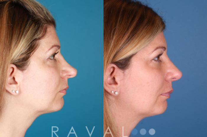 Before & After Rhinoplasty Case 1031 View 1 View in Denver, CO