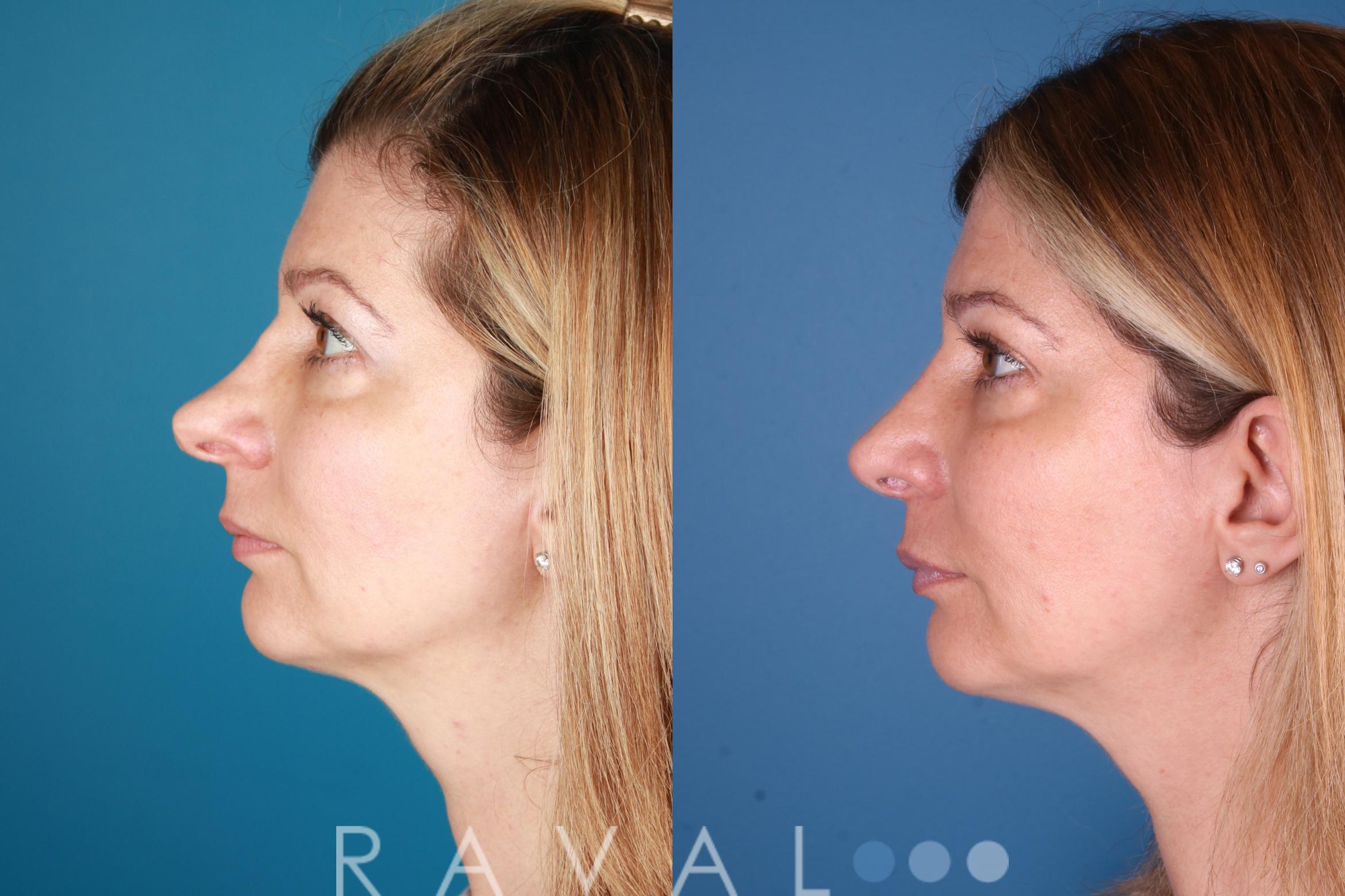 Before & After Rhinoplasty Case 1031 View 2 View in Denver, CO