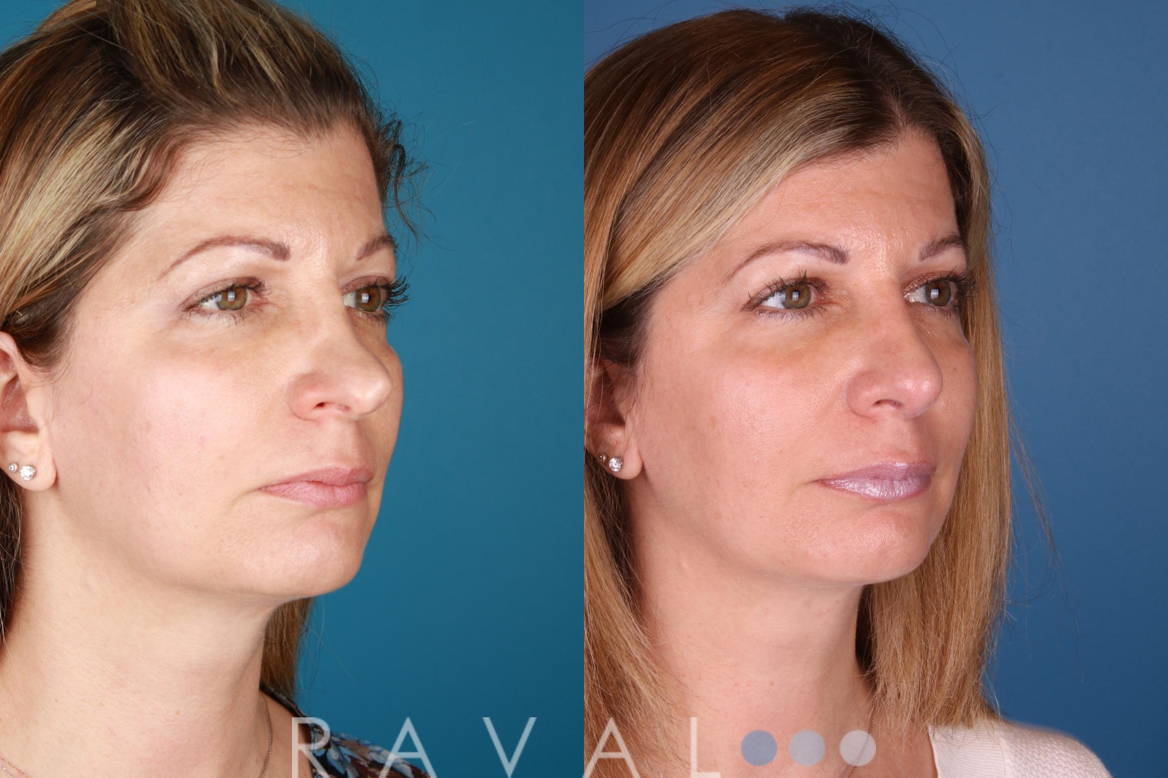 Before & After Rhinoplasty Case 1031 View 3 View in Denver, CO