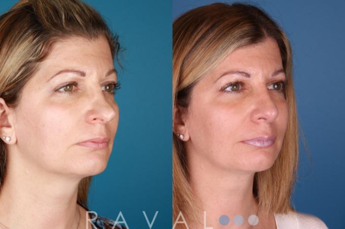 Before & After Rhinoplasty Case 1031 View 3 View in Denver, CO