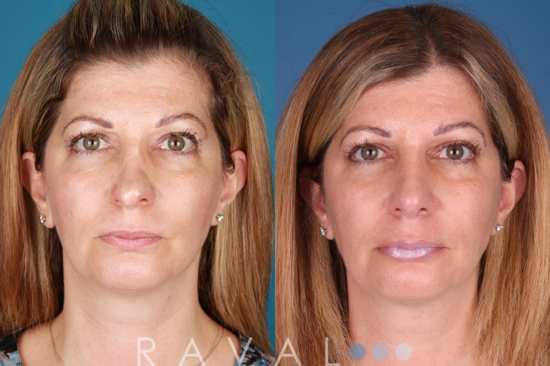 Before & After Rhinoplasty Case 1031 View 4 View in Denver, CO