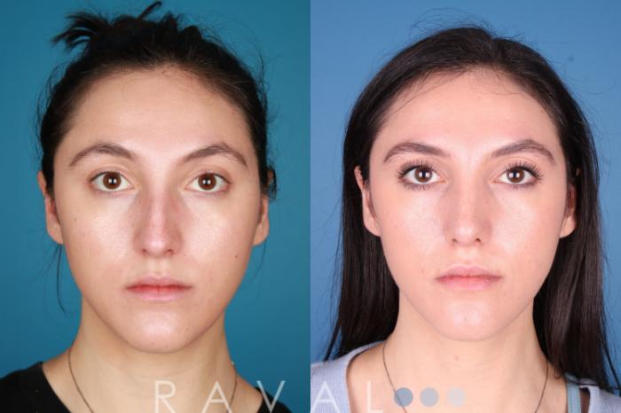 Before & After Rhinoplasty Case 1032 View 1 View in Denver, CO