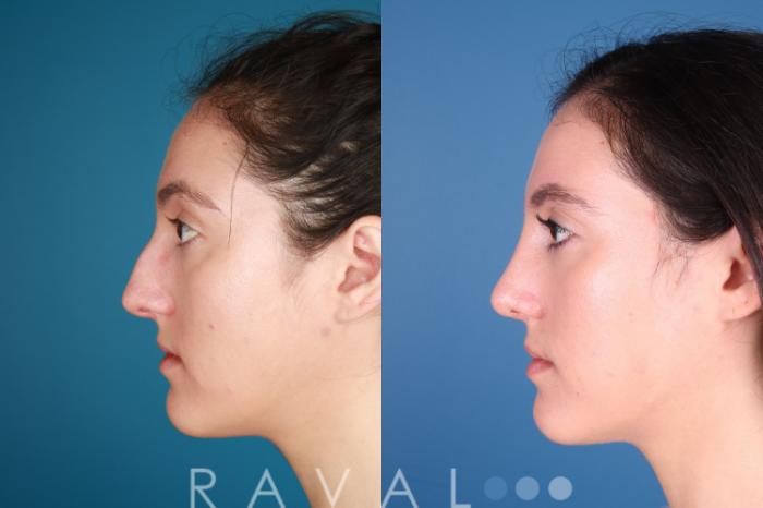 Before & After Rhinoplasty Case 1032 View 2 View in Denver, CO