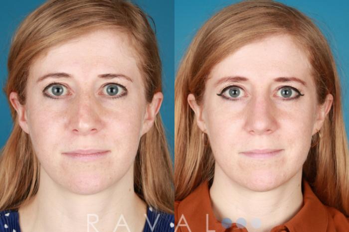 Before & After Rhinoplasty Case 1033 View 1 View in Denver, CO