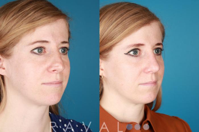 Before & After Rhinoplasty Case 1033 View 2 View in Denver, CO