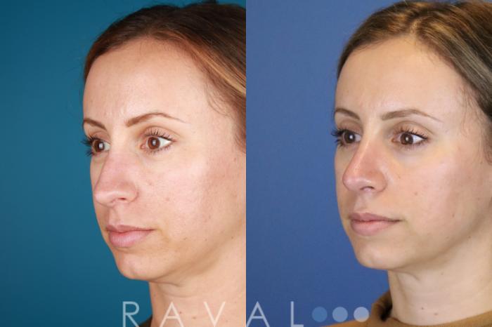 Before & After Rhinoplasty Case 1034 View 2 View in Denver, CO