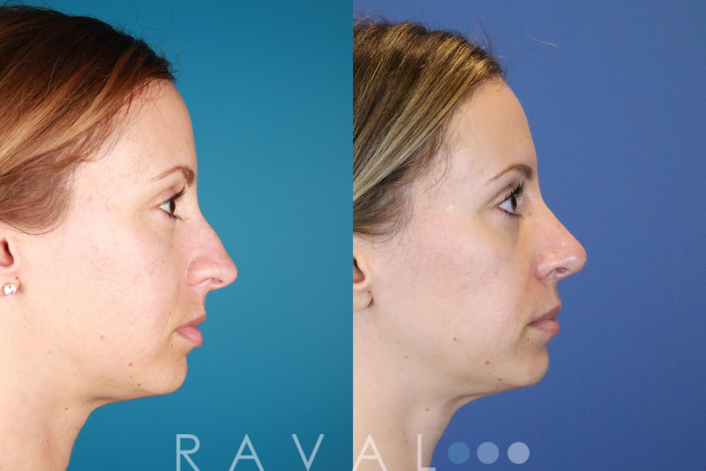 Before & After Rhinoplasty Case 1034 View 3 View in Denver, CO