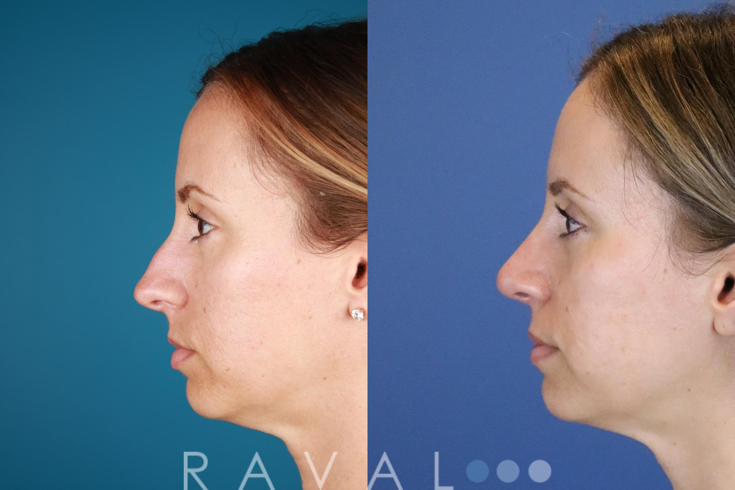 Before & After Rhinoplasty Case 1034 View 4 View in Denver, CO