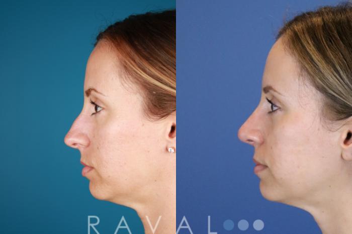 Before & After Rhinoplasty Case 1034 View 4 View in Denver, CO
