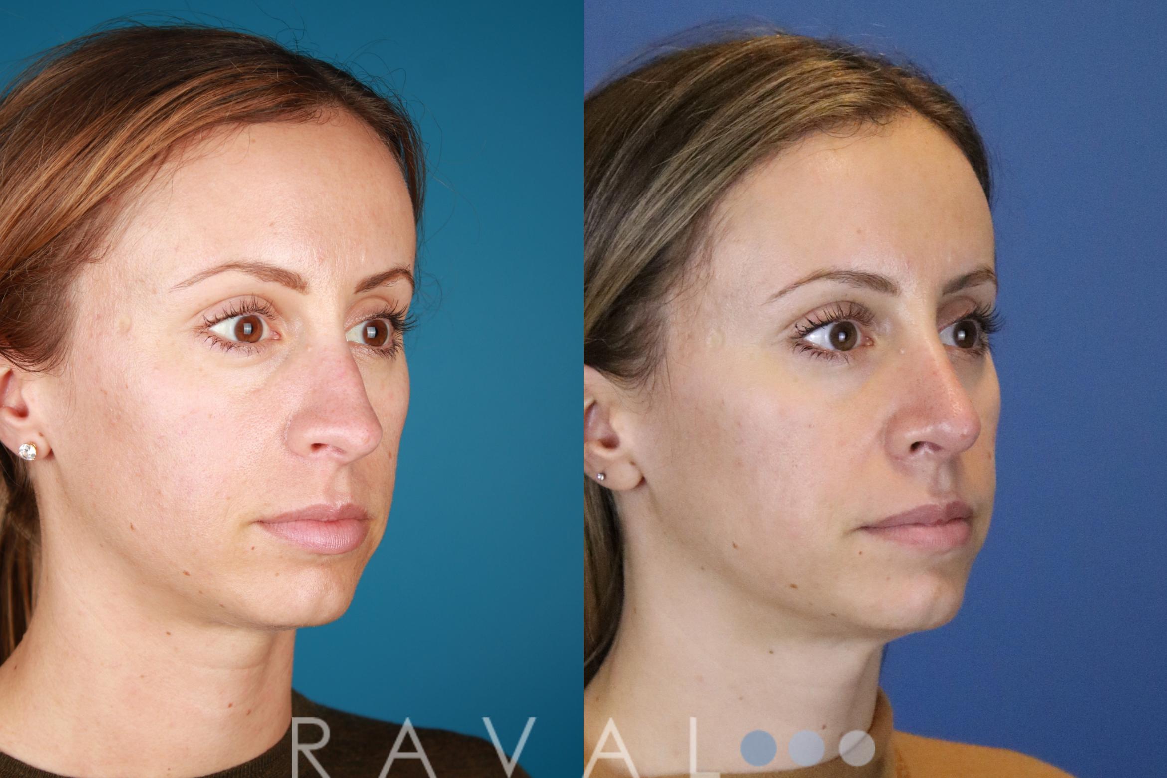Before & After Rhinoplasty Case 1034 View 5 View in Denver, CO