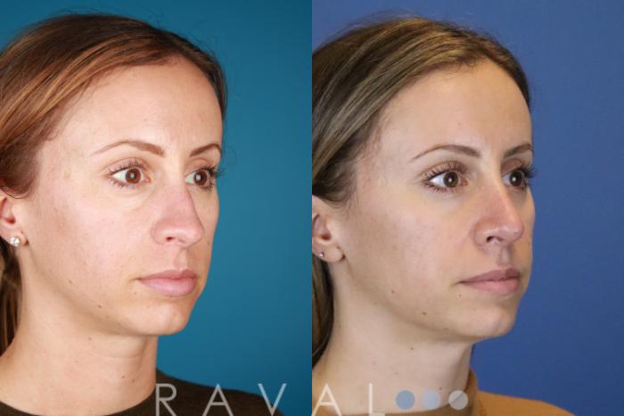Before & After Rhinoplasty Case 1034 View 5 View in Denver, CO