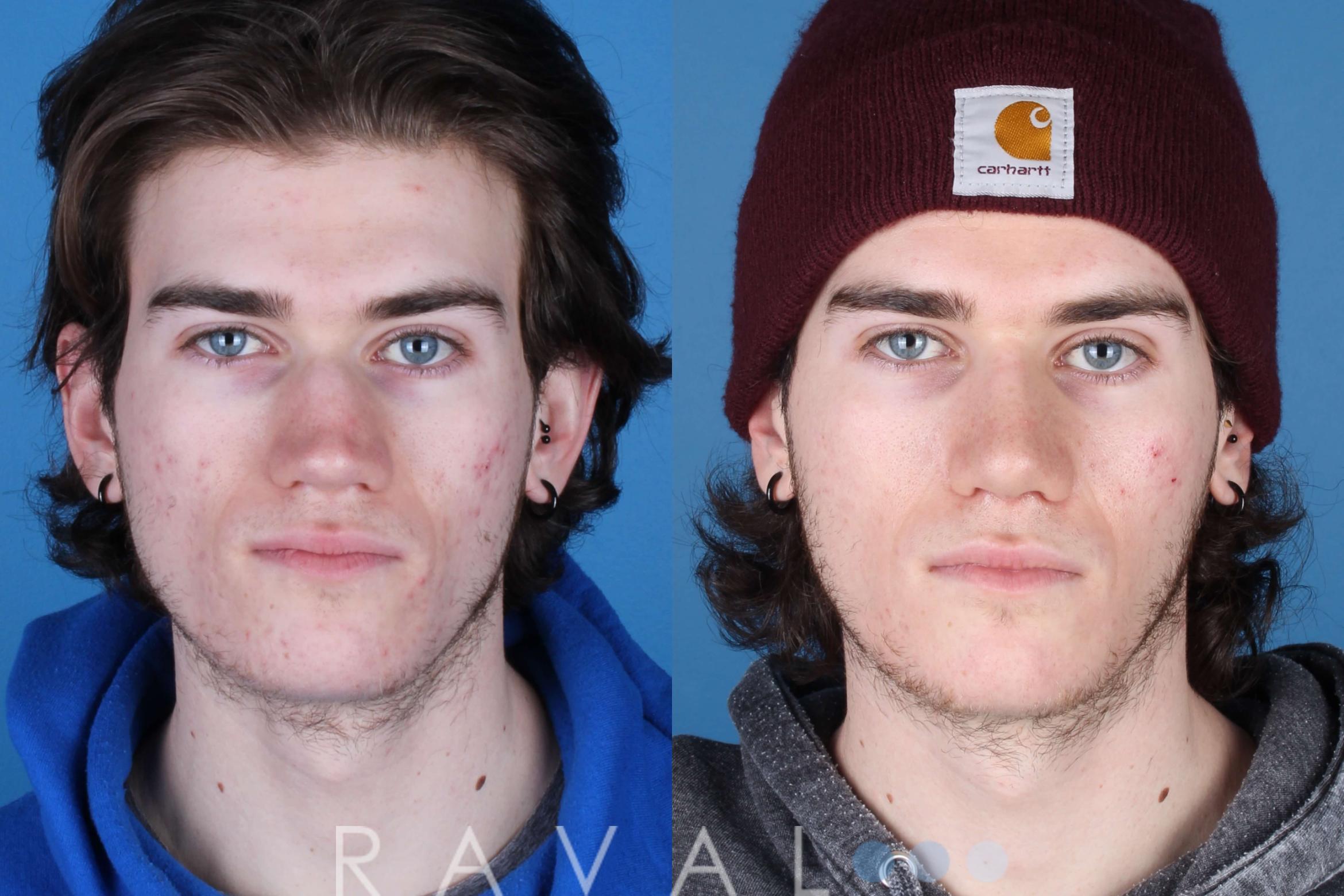 Before & After Rhinoplasty Case 1035 View 1 View in Denver, CO