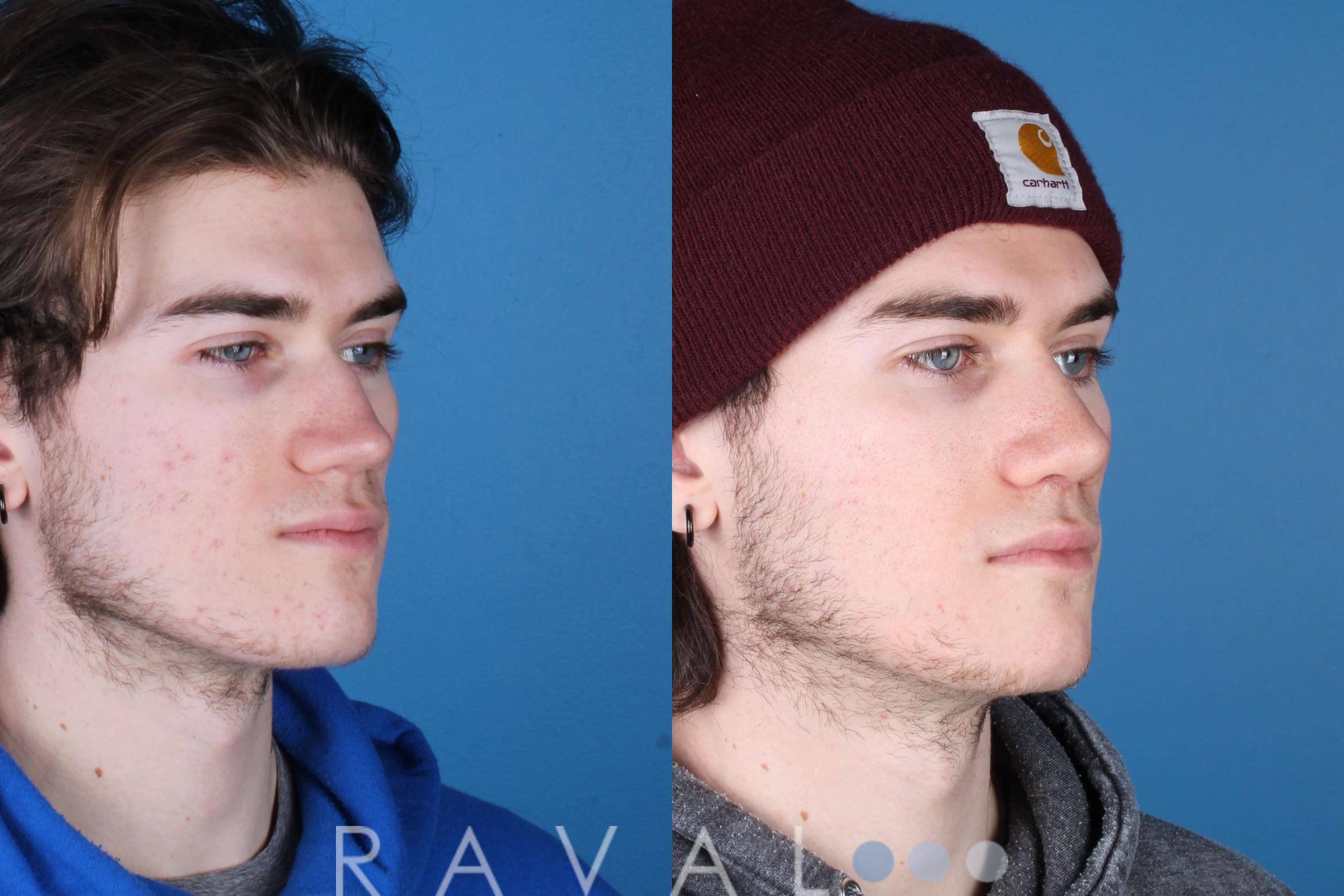 Before & After Rhinoplasty Case 1035 View 2 View in Denver, CO