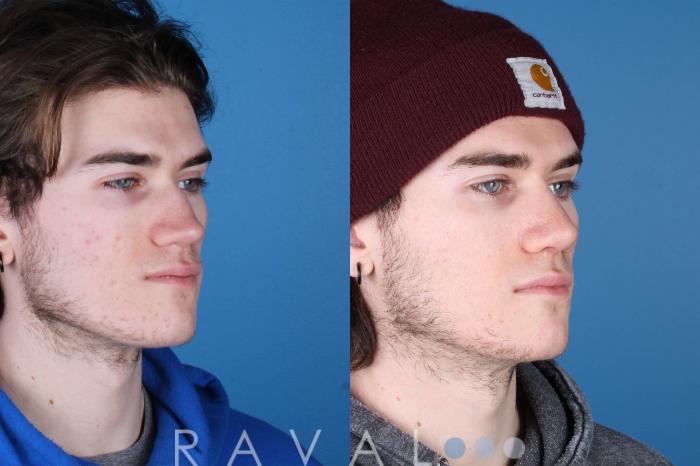 Before & After Rhinoplasty Case 1035 View 2 View in Denver, CO