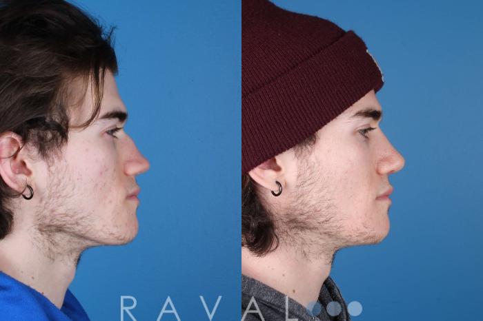 Before & After Rhinoplasty Case 1035 View 3 View in Denver, CO